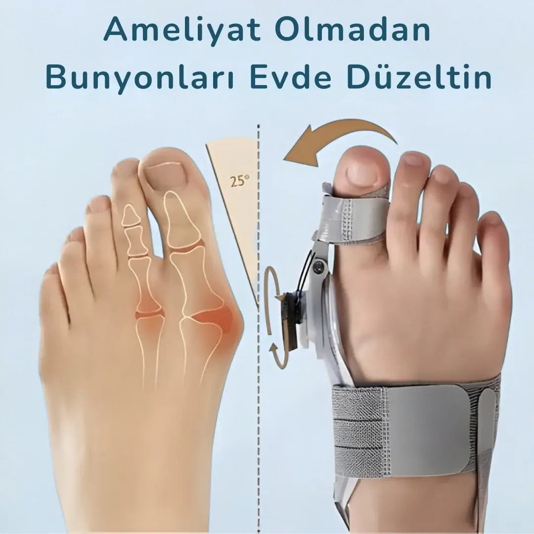Evona™ Ayak Baş Parmak Kemik Düzeltici ile ameliyatsız bunyon düzeltme işlemini gösteren bir görüntü.